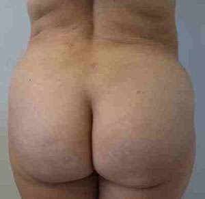Brazilian Butt Lift Before & After Patient #6775