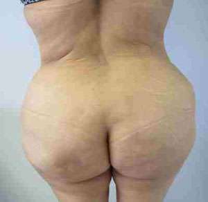 Brazilian Butt Lift Before & After Patient #6778