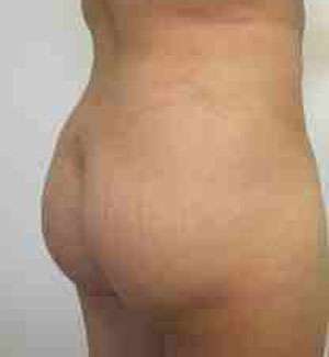 Brazilian Butt Lift Before & After Patient #6781