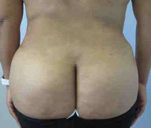 Brazilian Butt Lift Before & After Patient #6784