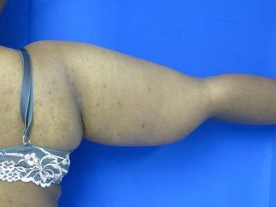 Arm Lift Before & After Patient #5923