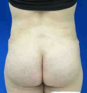 Brazilian Butt Lift Before & After Patient #6790