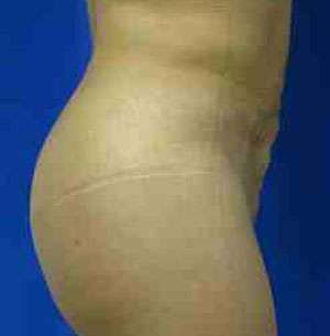 Brazilian Butt Lift Before & After Patient #6793