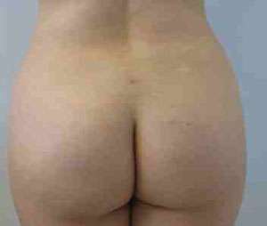 Brazilian Butt Lift Before & After Patient #6796