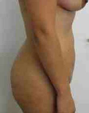 Brazilian Butt Lift Before & After Patient #6799
