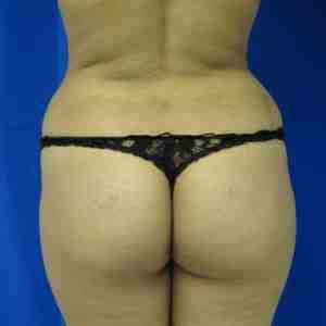 Brazilian Butt Lift Before & After Patient #6804
