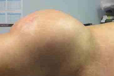 Brazilian Butt Lift Before & After Patient #6809
