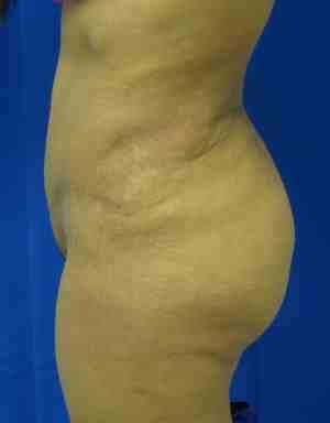 Brazilian Butt Lift Before & After Patient #6814