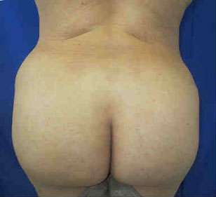 Brazilian Butt Lift Before & After Patient #6822