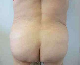 Brazilian Butt Lift Before & After Patient #6825