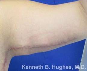 Arm Lift Before & After Patient #5932