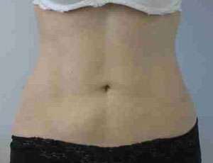 Liposuction Before & After Patient #6838