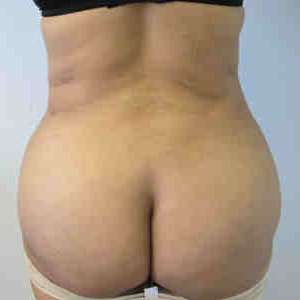 Brazilian Butt Lift Before & After Patient #6844