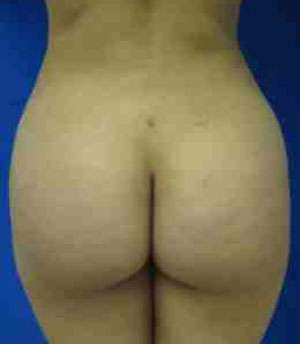 Brazilian Butt Lift Before & After Patient #6849