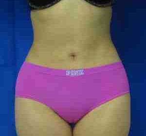 Liposuction Before & After Patient #6852