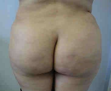 Brazilian Butt Lift Before & After Patient #6855