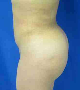 Brazilian Butt Lift Before & After Patient #6863