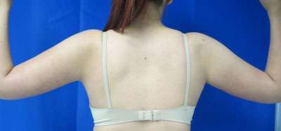 Arm Lift Before & After Patient #5935