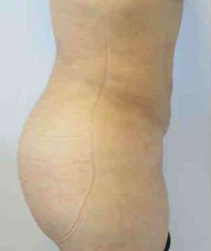Brazilian Butt Lift Before & After Patient #6868