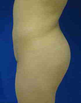 Brazilian Butt Lift Before & After Patient #6873