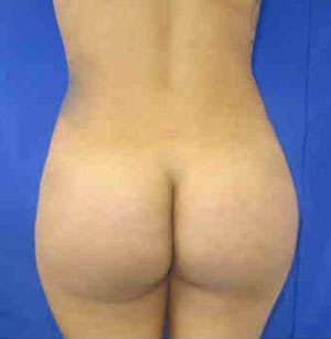 Brazilian Butt Lift Before & After Patient #6878