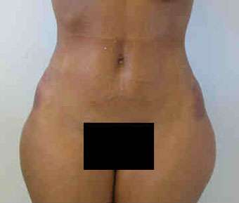 Brazilian Butt Lift Before & After Patient #6883