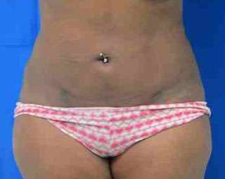 Brazilian Butt Lift Before & After Patient #6886
