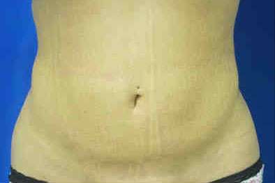 Liposuction Before & After Patient #6889