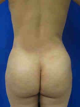 Brazilian Butt Lift Before & After Patient #6895