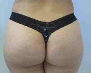Brazilian Butt Lift Before & After Patient #6898