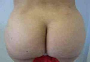 Brazilian Butt Lift Before & After Patient #6903