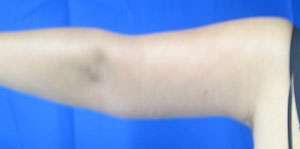 Arm Lift Before & After Patient #5940