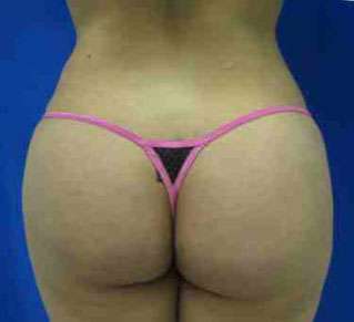 Brazilian Butt Lift Before & After Patient #6906