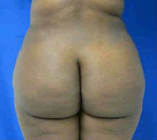 Brazilian Butt Lift Before & After Patient #6909