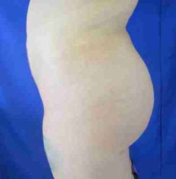 Brazilian Butt Lift Before & After Patient #6919