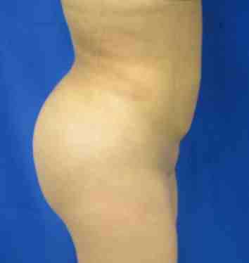 Brazilian Butt Lift Before & After Patient #6922