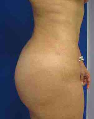Brazilian Butt Lift Before & After Patient #6925