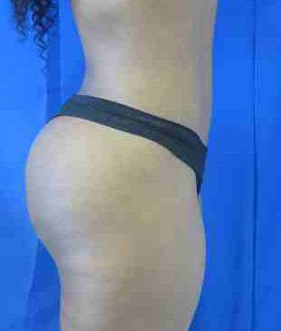 Brazilian Butt Lift Before & After Patient #6930