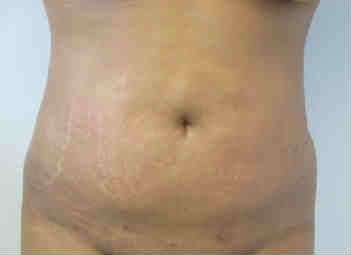 Brazilian Butt Lift Before & After Patient #6935