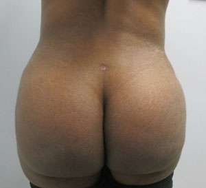 Brazilian Butt Lift Before & After Patient #6940