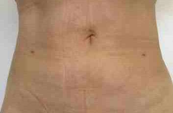 Brazilian Butt Lift Before & After Patient #6945