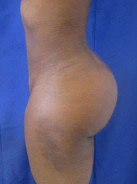 Brazilian Butt Lift Before & After Patient #6948