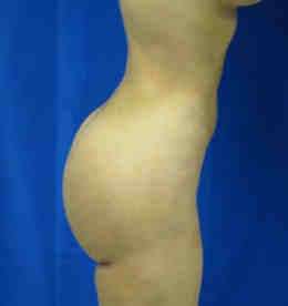 Brazilian Butt Lift Before & After Patient #6951