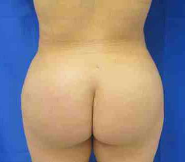 Brazilian Butt Lift Before & After Patient #6957