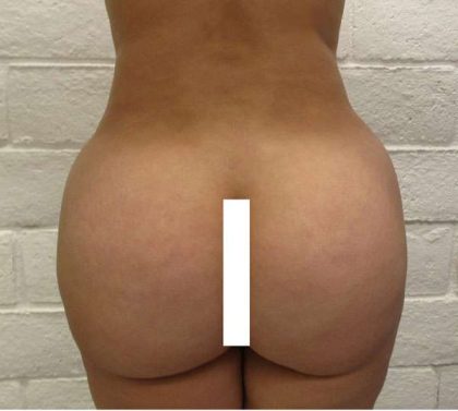 Brazilian Butt Lift for Thinner Patients Before & After Patient #6960