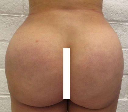 Brazilian Butt Lift for Thinner Patients Before & After Patient #6963