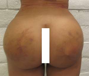 Brazilian Butt Lift for Thinner Patients Before & After Patient #6966