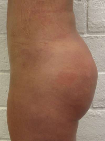 Brazilian Butt Lift for Thinner Patients Before & After Patient #6990