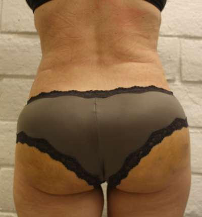 Brazilian Butt Lift for Thinner Patients Before & After Patient #7010