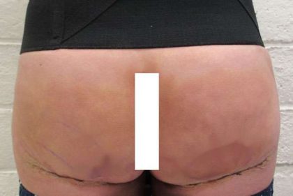 Body Lift Before & After Patient #5963